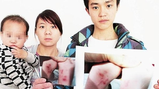 2岁男童因哭闹被幼师用指甲在其脚板心挖出20道