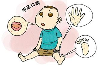 健康养生 正文  手足口病也称为"手口足综合征",是由肠道病毒引起的发