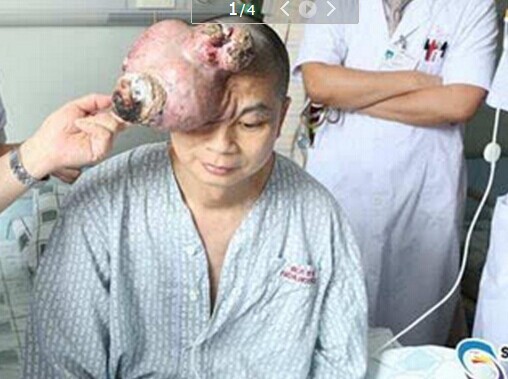 今天上午,邓先生在广州做切除手术,切除的神经纤维瘤重达3508_379