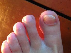 甲沟炎是什么症状呢 b1315c7fafd7c2b4b113353246f952e6.jpg?_=1472631556027