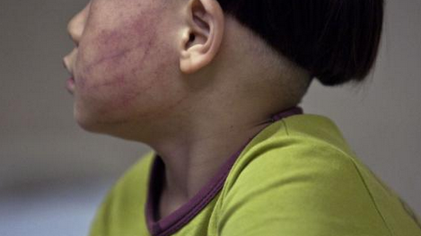 广州5岁男童遭女幼师掌掴 全身多处软组织挫伤