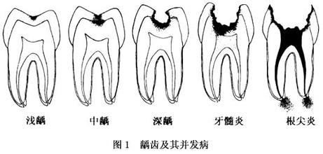 龋齿的原因的原因是什么 要怎么进行预防和治