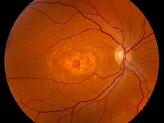 谷歌欲教计算机诊断眼疾 开创新领域