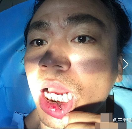 受伤缝针后吃什么比较好 426d0bab52c09cd2f6a52eac9b49feb0.png