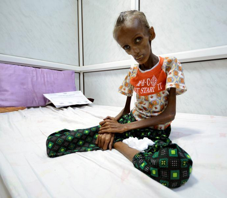 摘要:也门荷台达,18岁的saidaahmadbaghil因严重营养