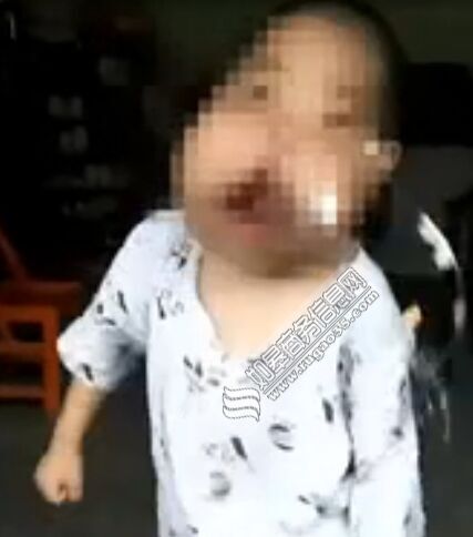 5岁男孩脸似河马 从小患上罕见巨颌症