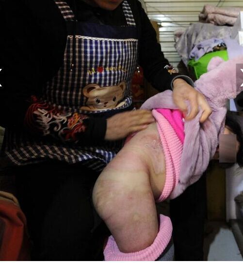 3岁女童掉热水桶 腰身以下多处皮肤脱落