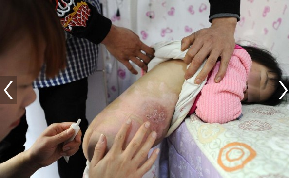 3岁女童掉热水桶 浑身多处烫伤