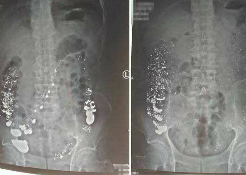 男子赌气喝4斤水银 幸得被医院成功救治!