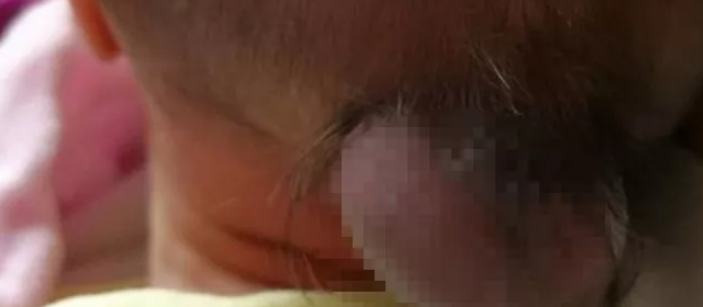男婴脑袋上长尾巴 专家说或因孕妈没补够叶酸