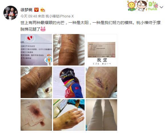 徐梦桃晒术后伤口 配文终于摆脱棉花腿