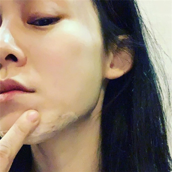 范玮琪下巴缝15针 伤口约两英寸但很深
