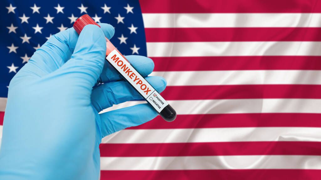 截至目前美国境内共检测出460例猴痘确诊病例