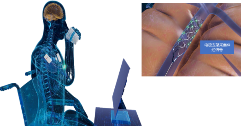 脑机接口风口下的价值重估，心玮医疗-B（6609.HK）的技术卡位与资本进阶