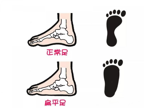 16年凤凰平台官网注册让扁平足孩子在世界步行日也能快乐行走，专业的矫正鞋少不了